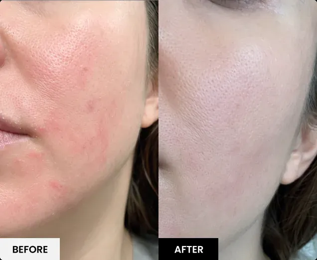 Before and after comparison 3 published by Glokore; results vary