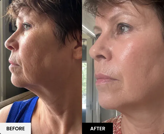 Before and after comparison 1 published by Glokore; results vary